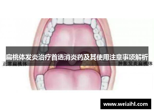 扁桃体发炎治疗首选消炎药及其使用注意事项解析